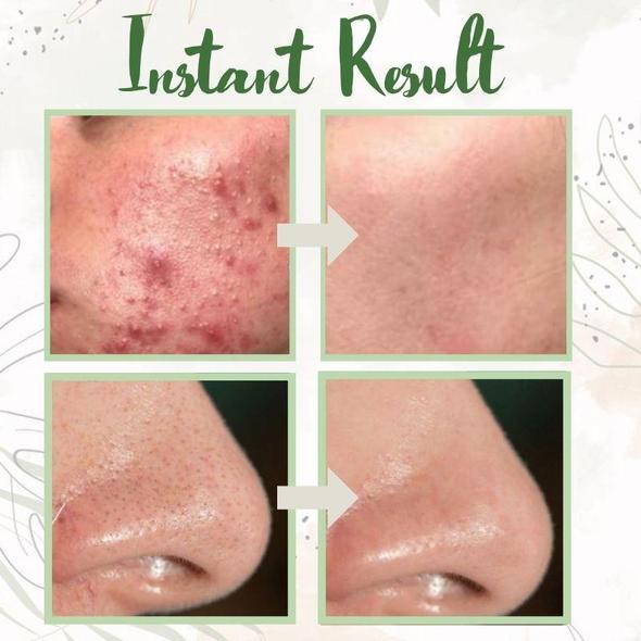 (🔥LAST DAY SALE-80% OFF) Final Sale -LOVILDS Green Tea Deep Cleanse Mask