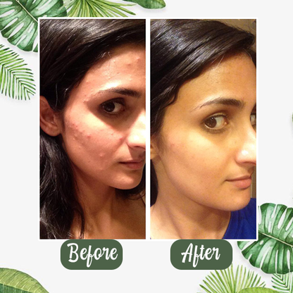 （🔥LAST DAY SALE-80% OFF) Final Sale -LOVILDS Green Tea Deep Cleanse Mask